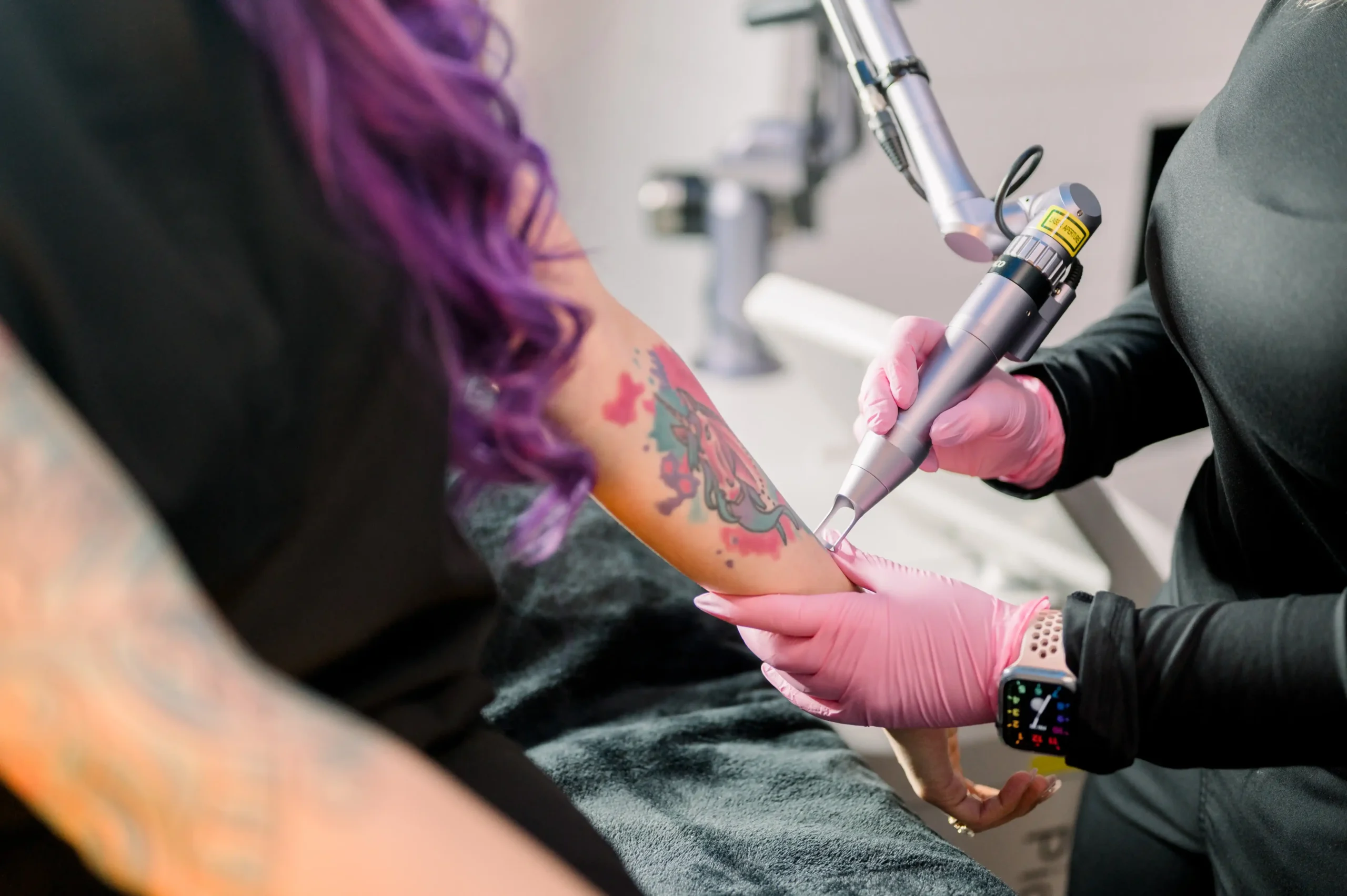 Tattoo Removal-B-inTuscaloosa,AL