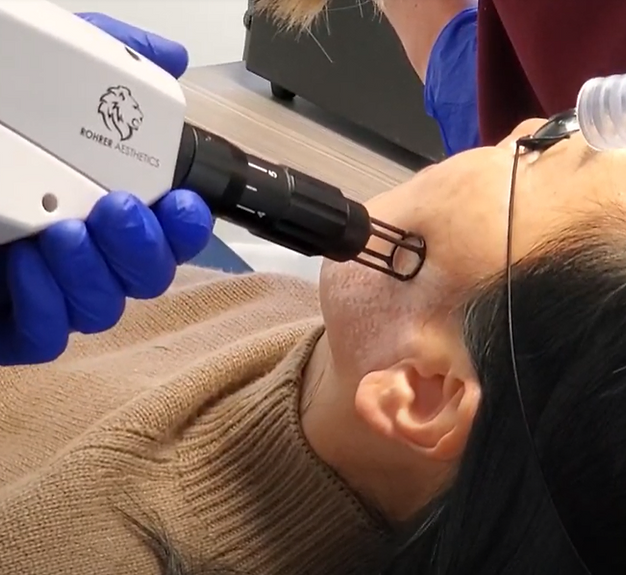 a person using a device to remove the forehead of a woman