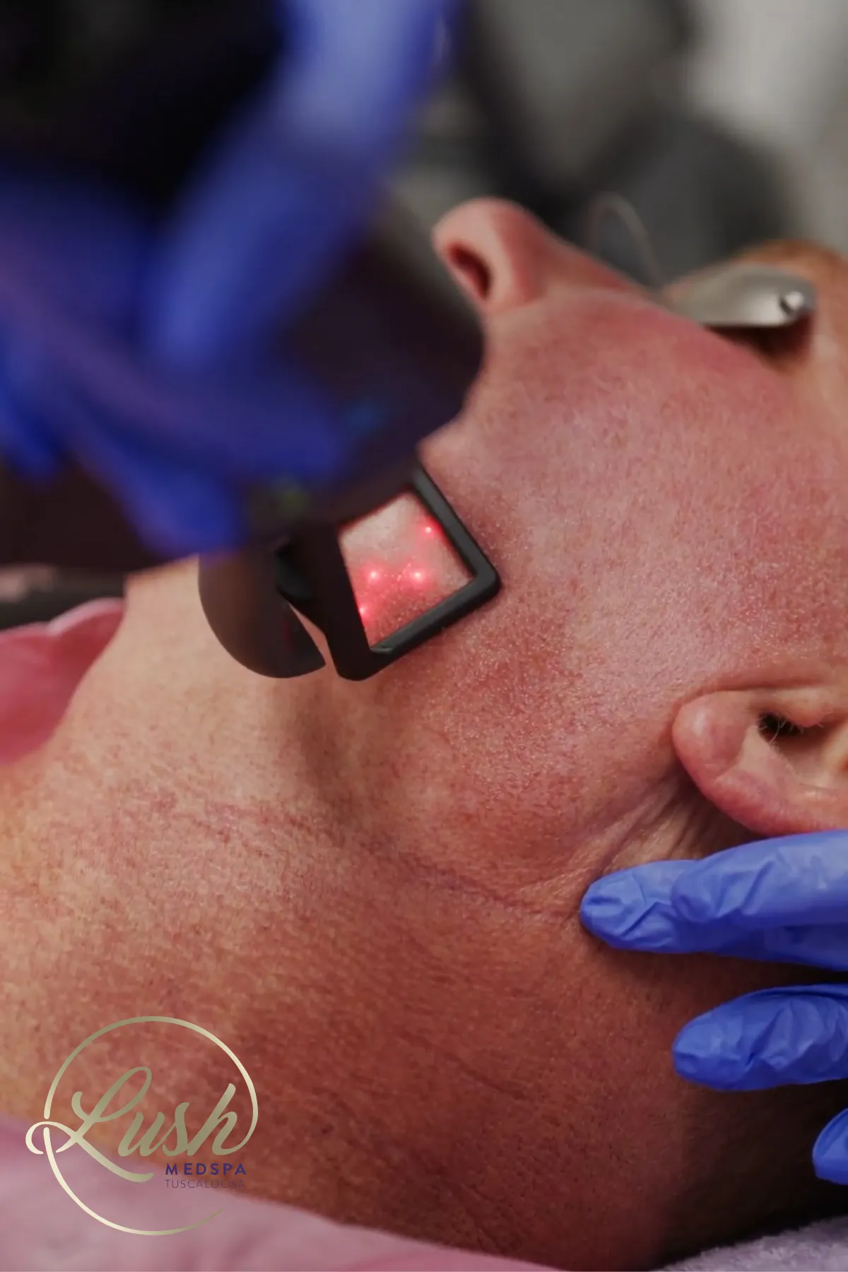 Cool Peel in Tuscaloosa, AL - Lush Medspa Tuscaloosa