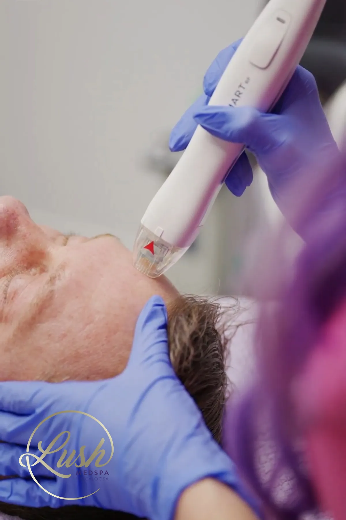 Microneedling Treatment in Tuscaloosa, AL | Lush Medspa