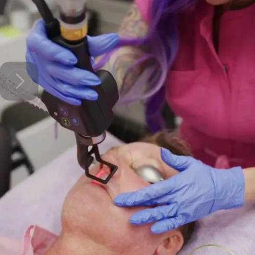 CoolPeel Laser with Morgan