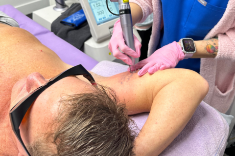Pico Laser Tattoo Removal & Beyond