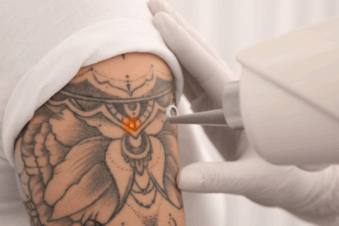 Laser Tattoo Removal