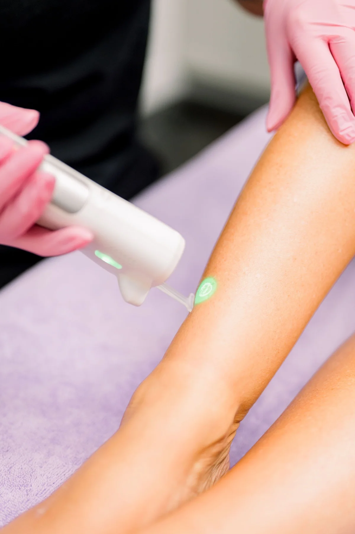 Laser Vein Removal at Lush Med Spa Tuscaloosa AL