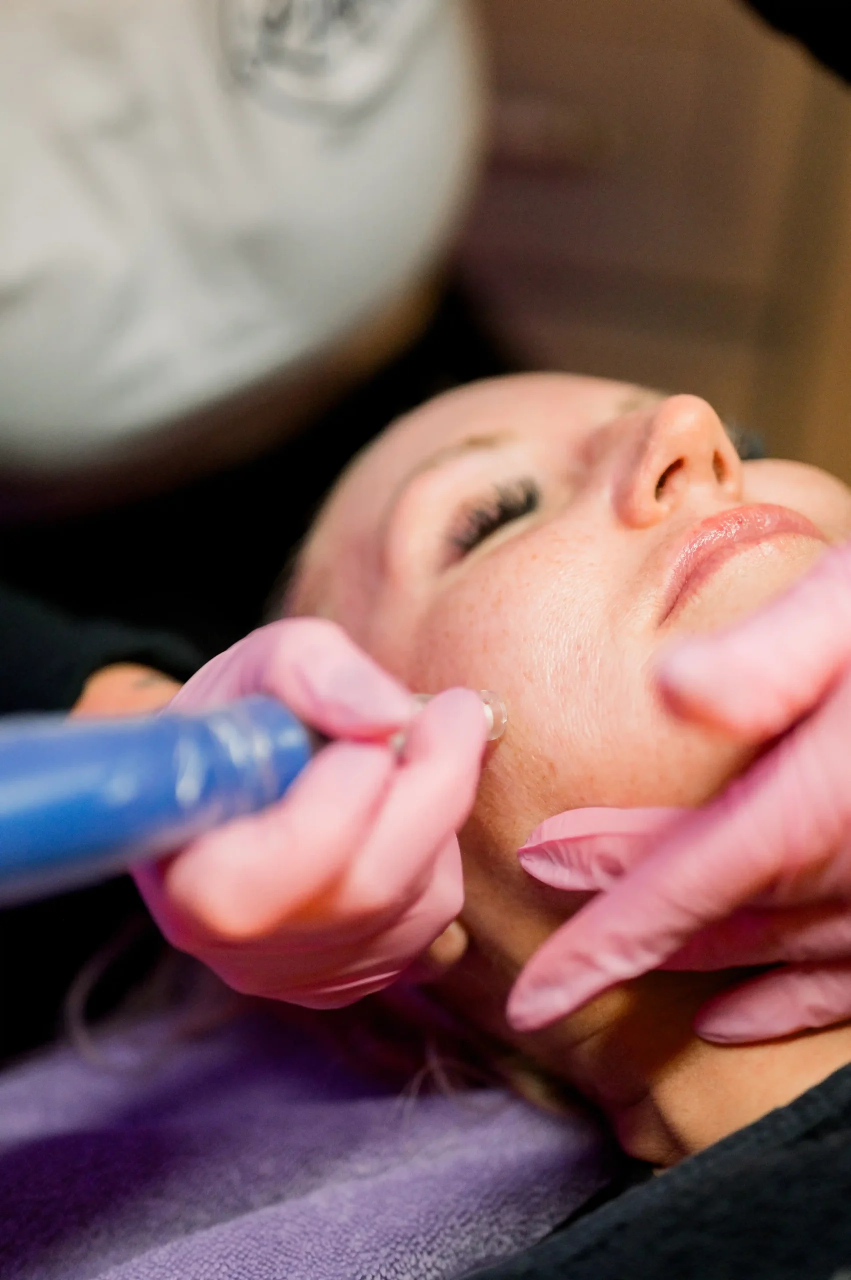 Microneedling at Lush MedSpa Tuscaloosa
