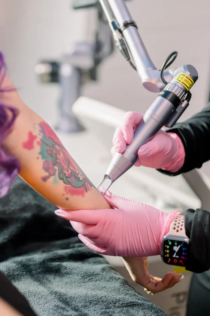 Tattoo Removal at Lush Med Spa Tuscaloosa AL