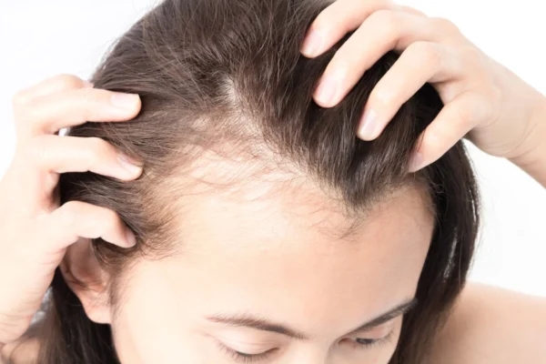 Top Scalp Treatments for Dryness: How to Restore Moisture and Hydration
