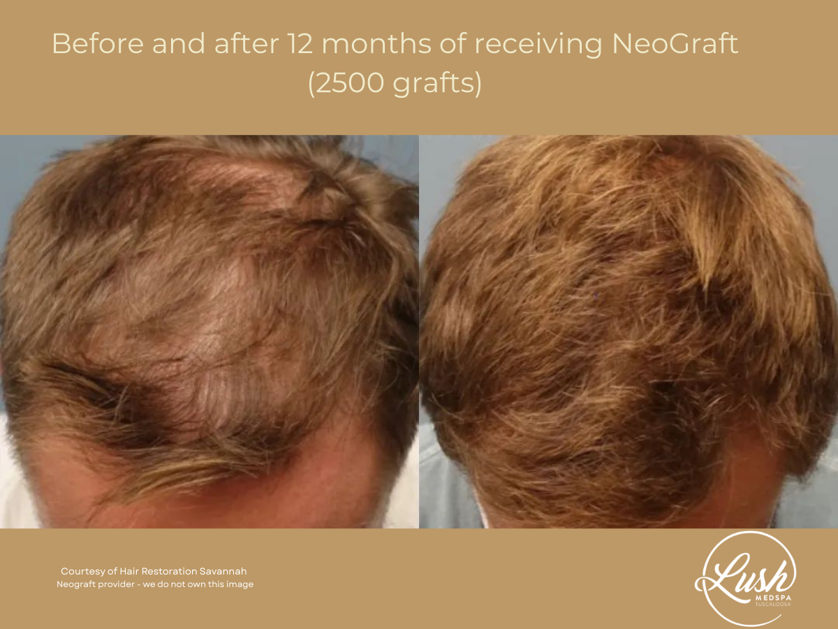 Before and after 12 months of receiving NeoGraft (2500 grafts) Lush MedSpa Tuscaloosa, AL