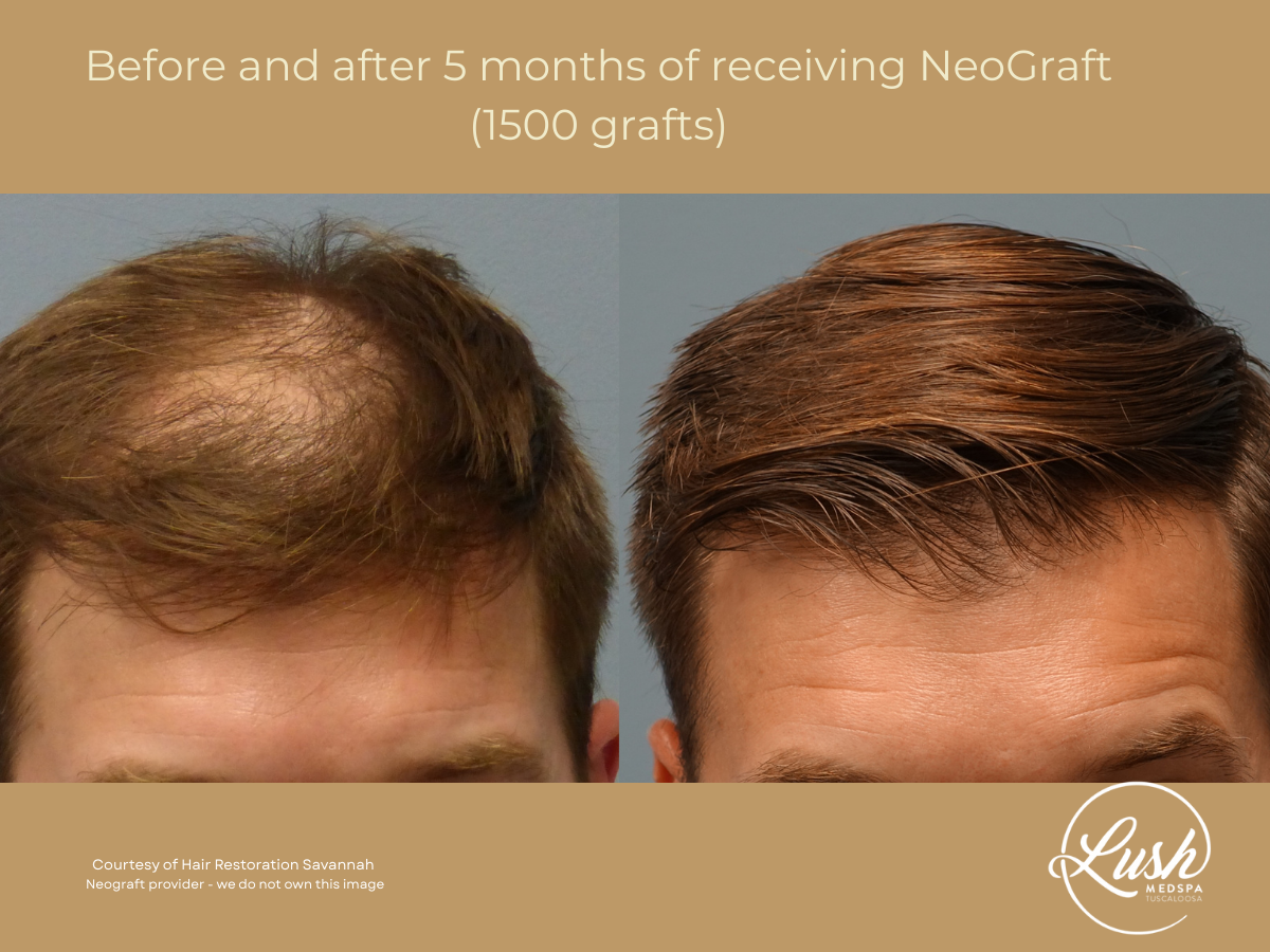 Before and after 5 months of receiving NeoGraft (1500 grafts) at Lush MedSpa Tuscaloosa, AL