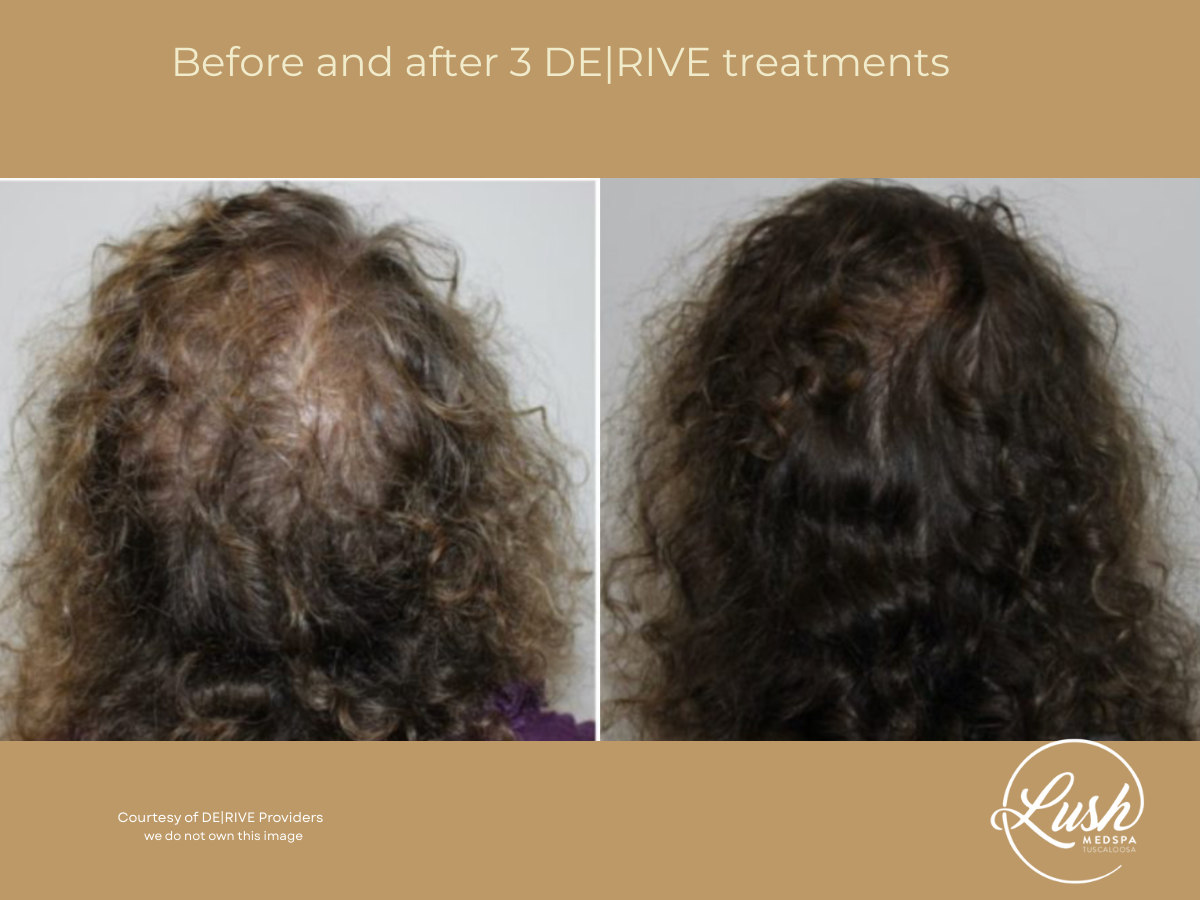 Before and after DE|RIVE at Lush MedSpa Tuscaloosa, AL