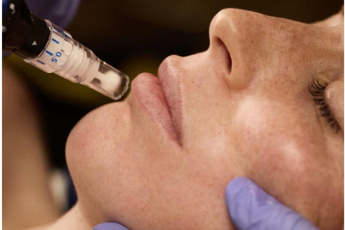 SkinPen at Lush MedSpa Tuscaloosa