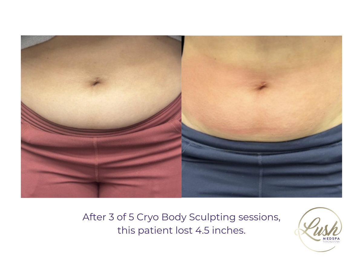 After 3 of 5 Cryo Body Sculpting sessions at Lush MedSpa Tuscaloosa , this patient lost 4.5 inches