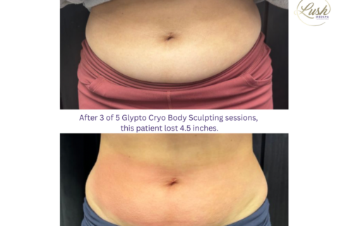 Glypto Cryo Body Sculpting
