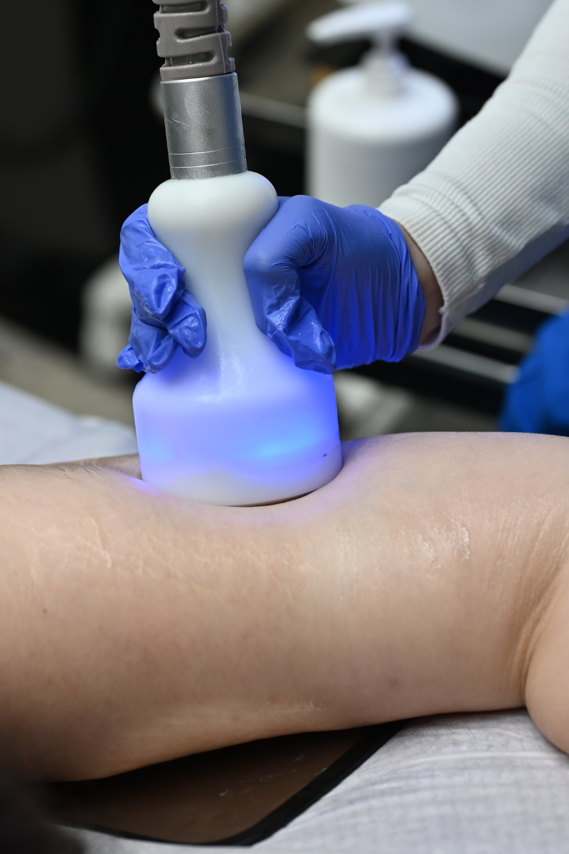 Cyro Body Sculpting at Lush Med Spa Tuscaloosa AL