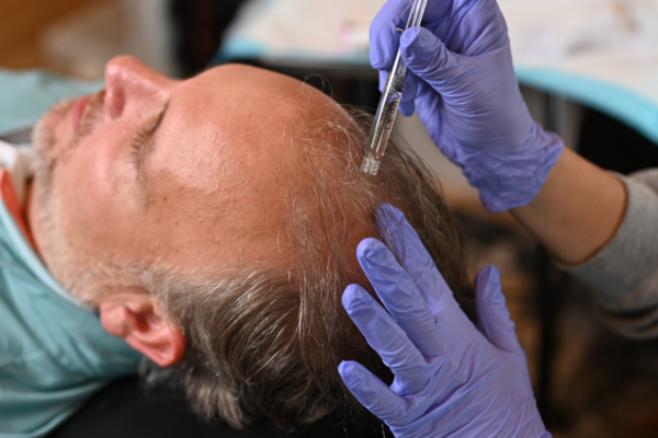 Needle-Free Hair Restoration in Tuscaloosa, Alabama with DE|RIVE Exosome Therapy