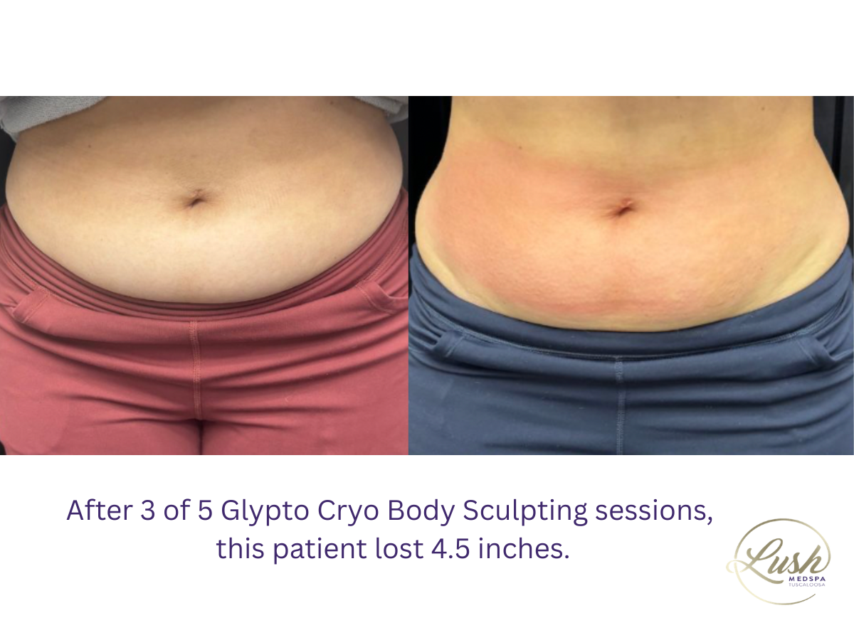 After 3 of 5 Glypto Cryo Body Sculpting sessions at Lush MedSpa Tuscaloosa , this patient lost 4.5 inches