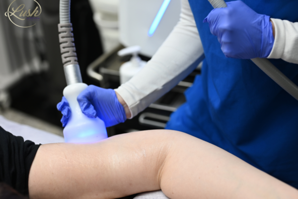 Glypto Cryo Body Sculpting in Tuscaloosa AL