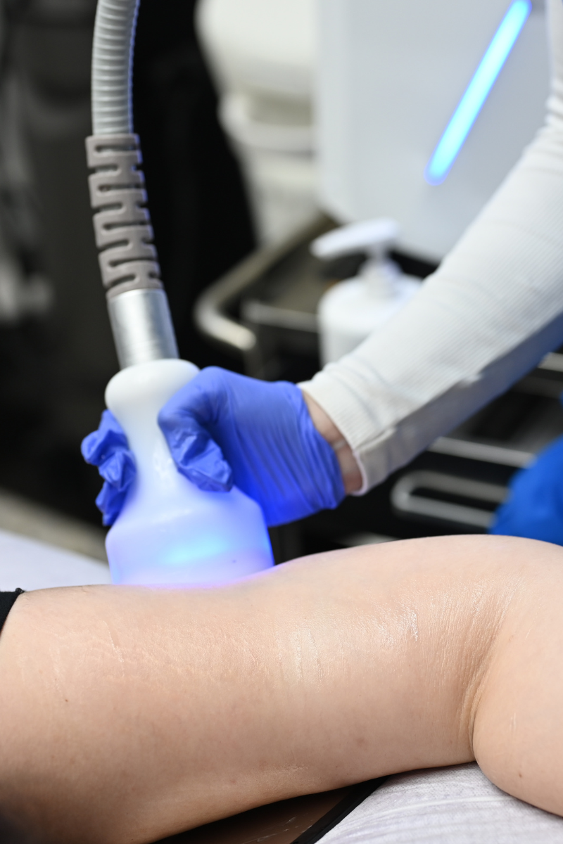 Glypto Cyro Body Sculpting at Lush MedSpa Tuscaloosa, AL