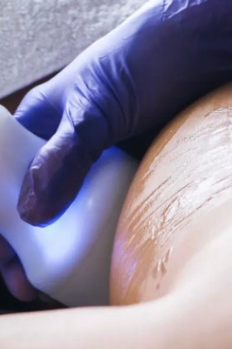 Glypto Cyro Body Sculpting in Tuscaloosa