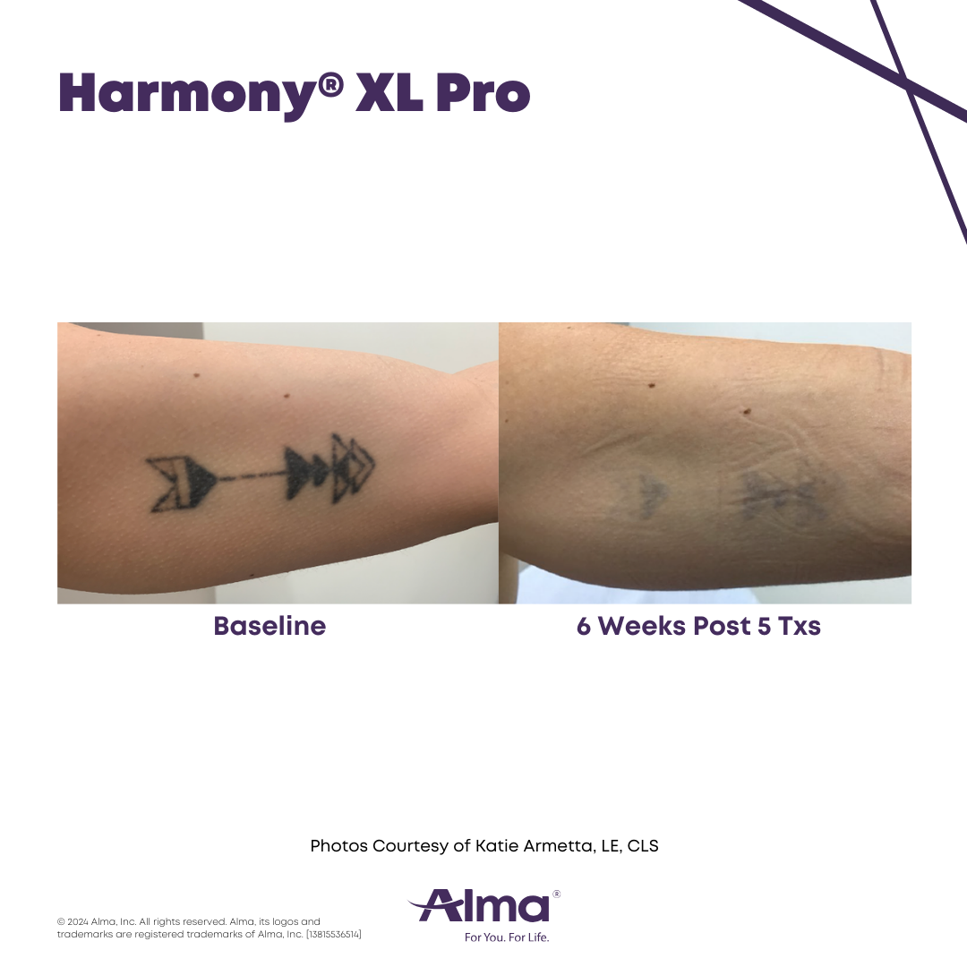 Before and After Harmony Alma Laser at Lush MedSpa Tuscaloosa, AL