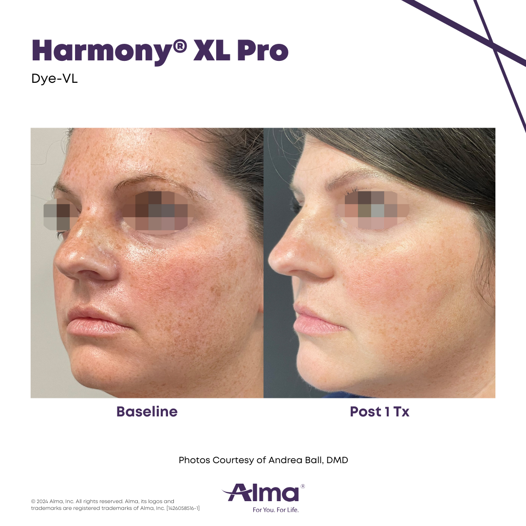 Before and After Harmony Alma Laser at Lush MedSpa Tuscaloosa, AL