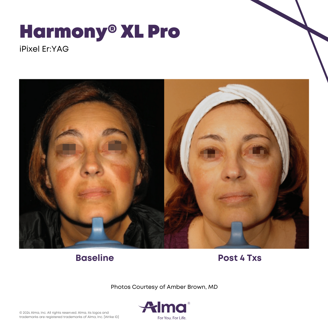 Before and After Harmony Alma Laser at Lush MedSpa Tuscaloosa, AL