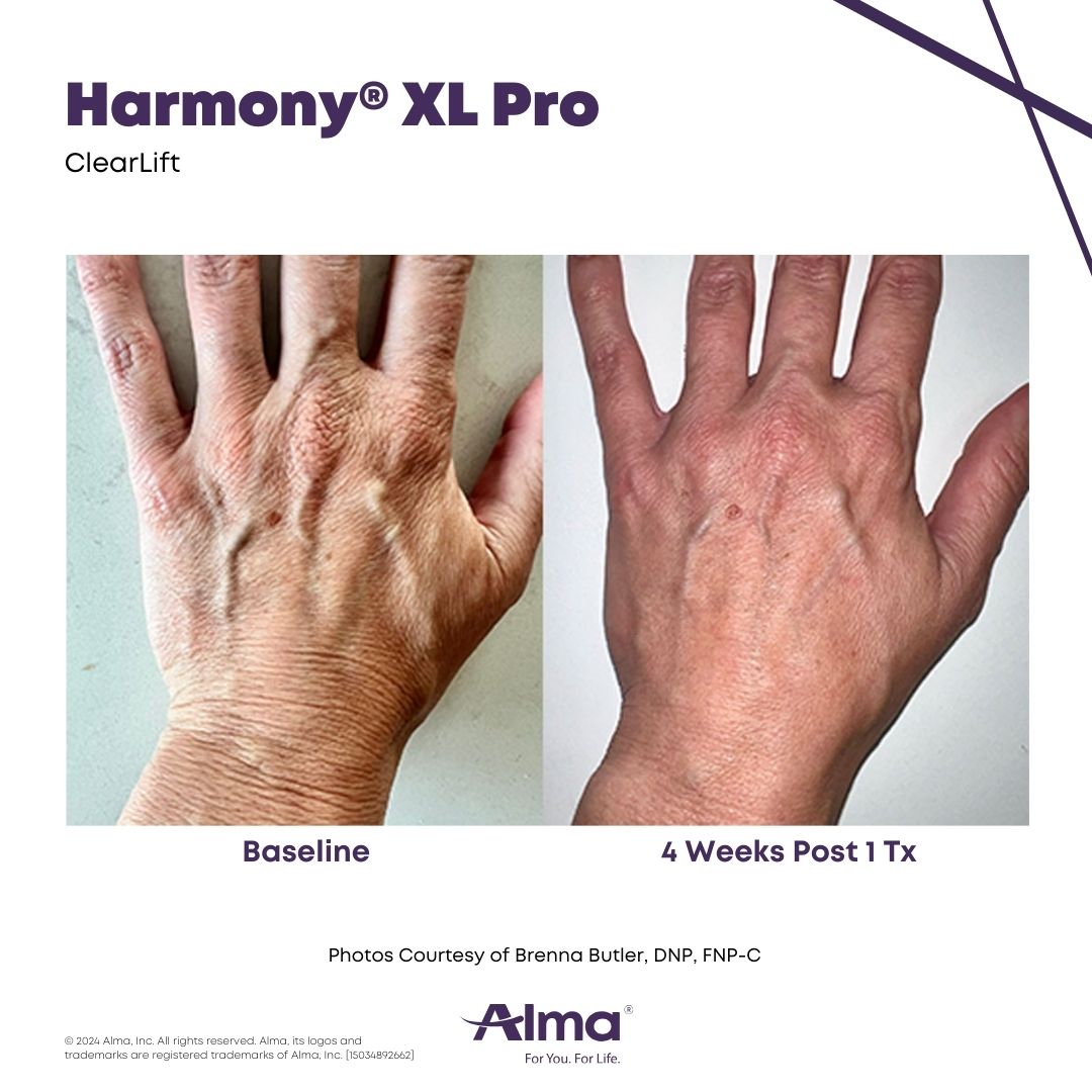 Before and After Harmony Alma Laser at Lush MedSpa Tuscaloosa, AL