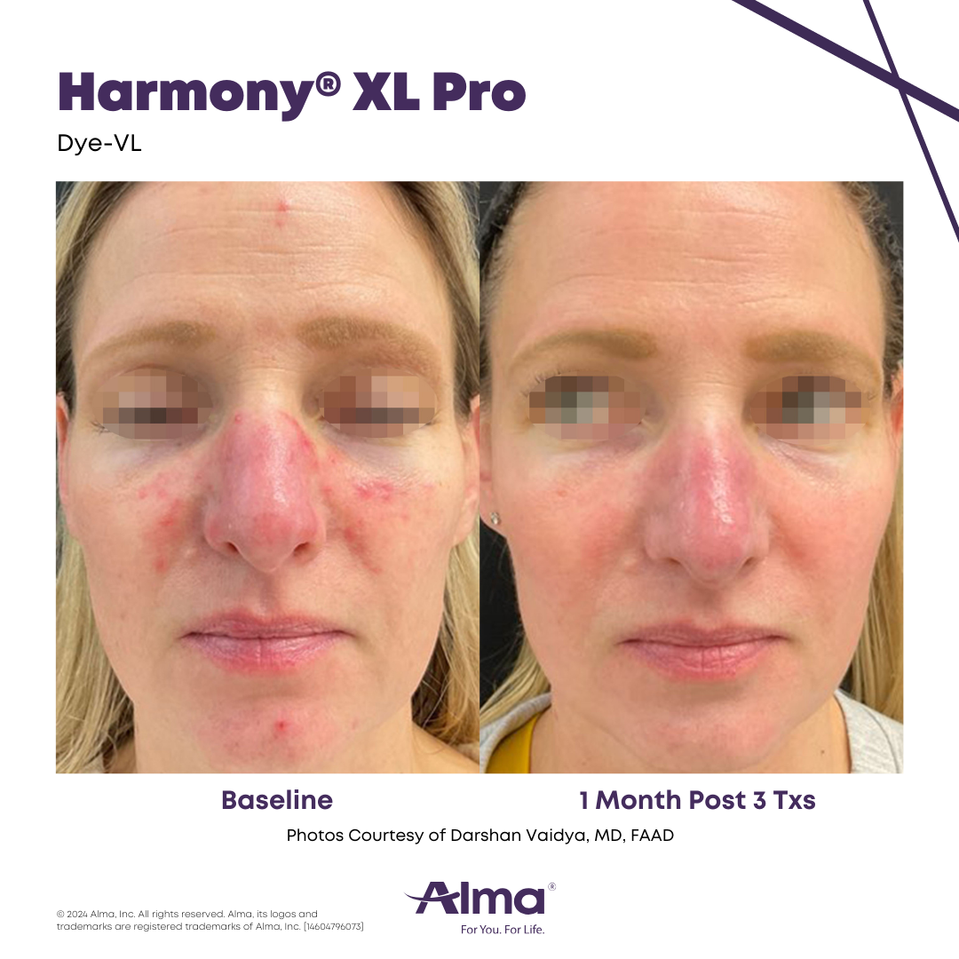 Before and After Harmony Alma Laser at Lush MedSpa Tuscaloosa, AL