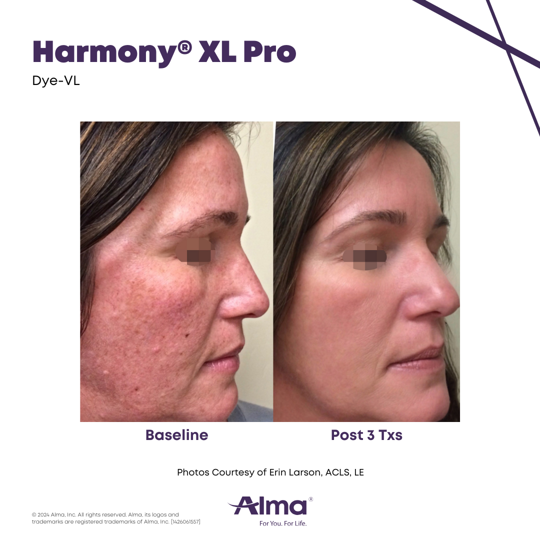 Before and After Harmony Alma Laser at Lush MedSpa Tuscaloosa, AL