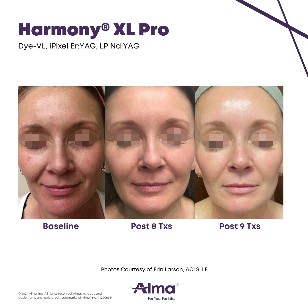 Before and After Harmony Alma Laser at Lush MedSpa Tuscaloosa, AL