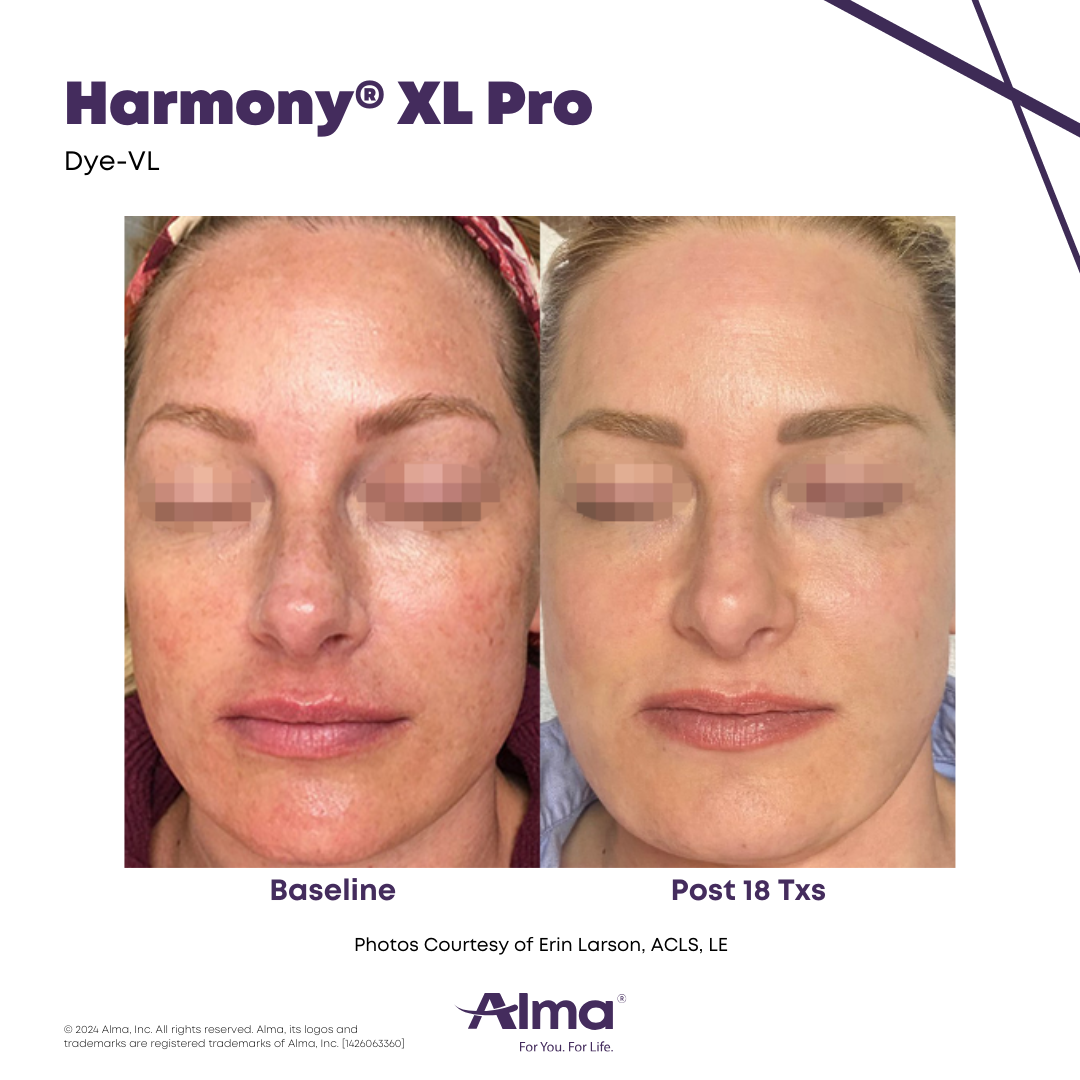 Before and After Harmony Alma Laser at Lush MedSpa Tuscaloosa, AL