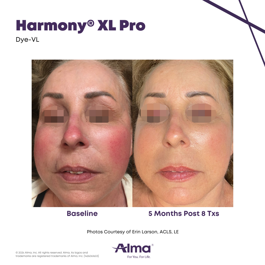 Before and After Harmony Alma Laser at Lush MedSpa Tuscaloosa, AL
