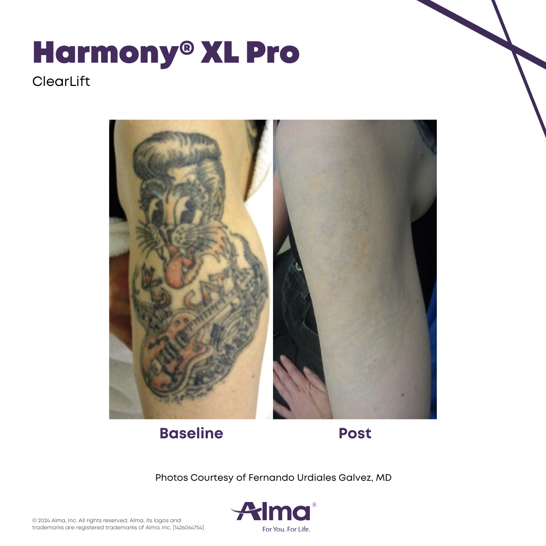 Before and After Harmony Alma Laser at Lush MedSpa Tuscaloosa, AL