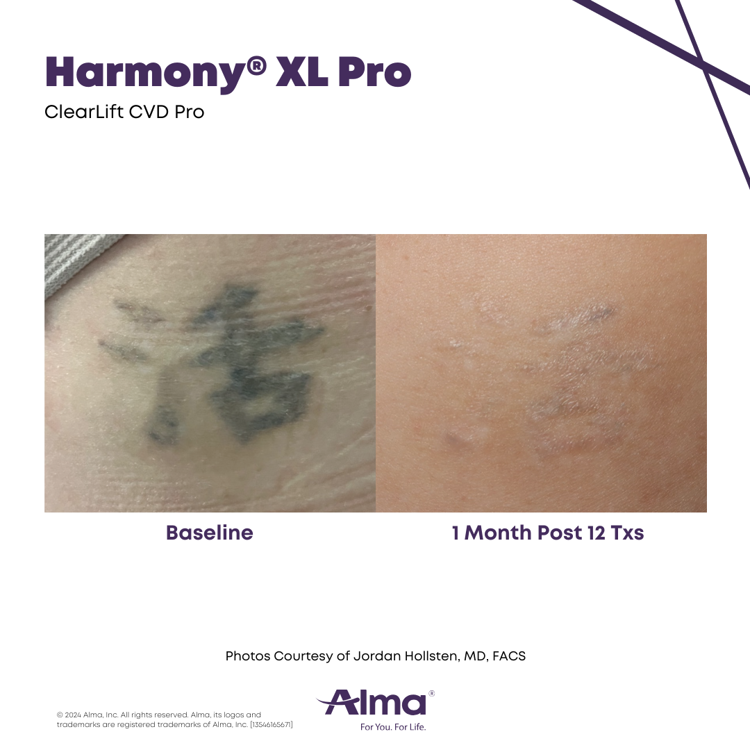 Before and After Harmony Alma Laser at Lush MedSpa Tuscaloosa, AL