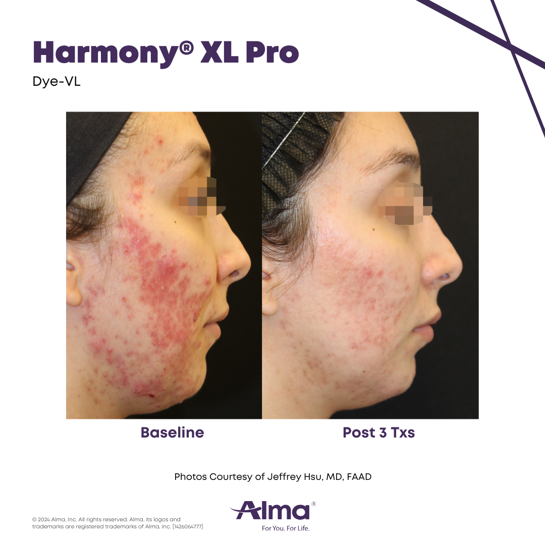 Before and After Harmony Alma Laser at Lush MedSpa Tuscaloosa, AL