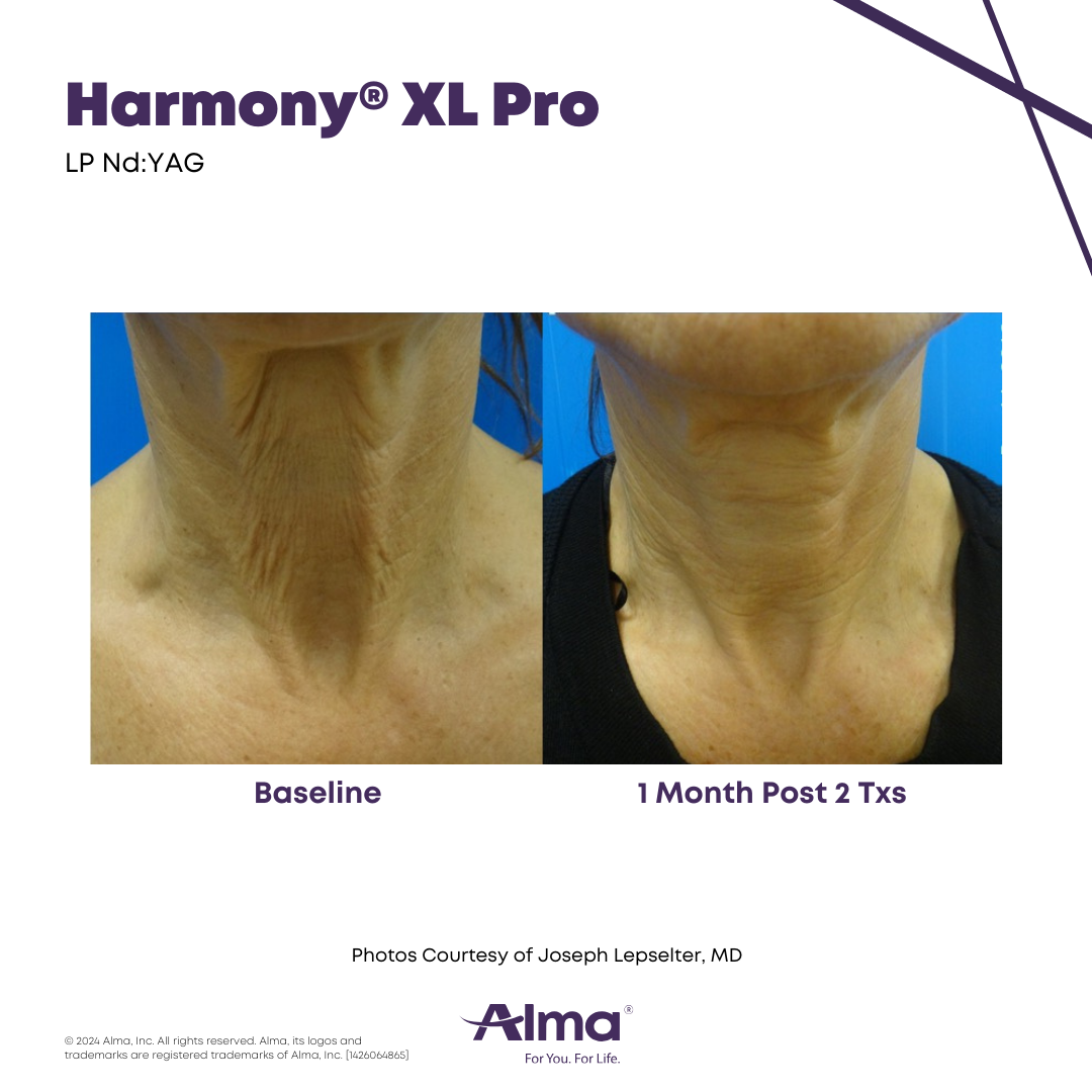 Before and After Harmony Alma Laser at Lush MedSpa Tuscaloosa, AL