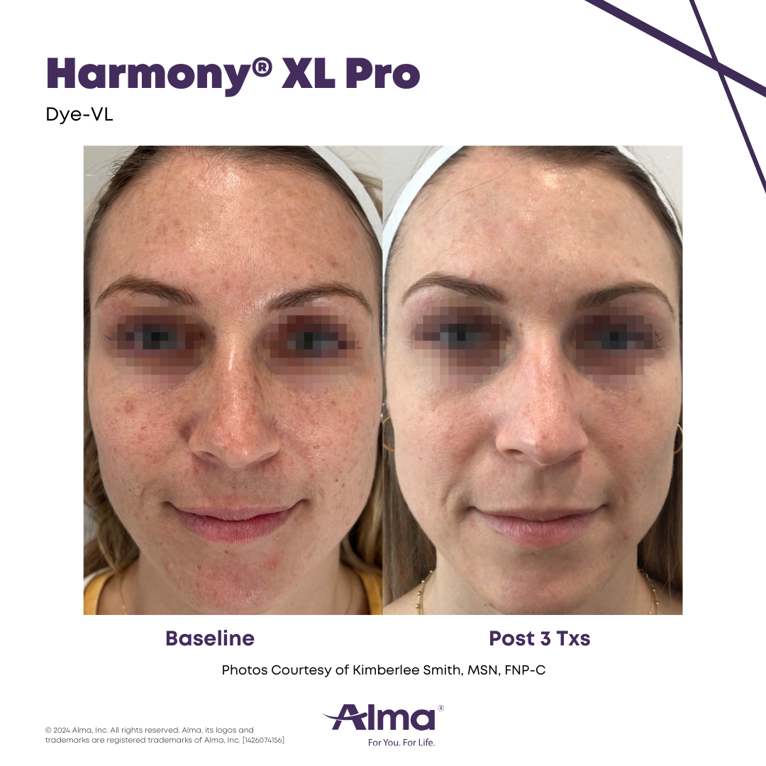 Before and After Harmony Alma Laser at Lush MedSpa Tuscaloosa, AL