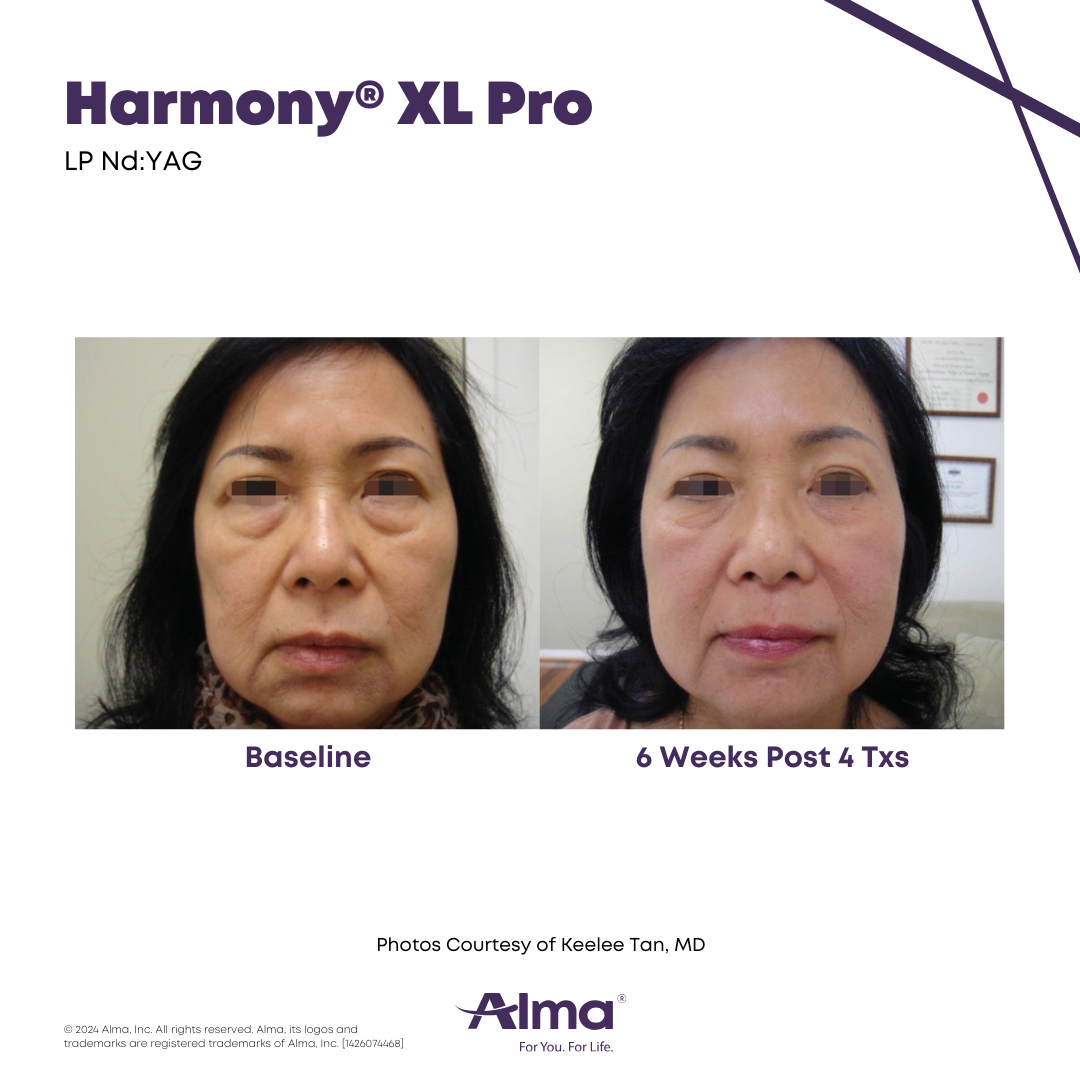 Before and After Harmony Alma Laser at Lush MedSpa Tuscaloosa, AL