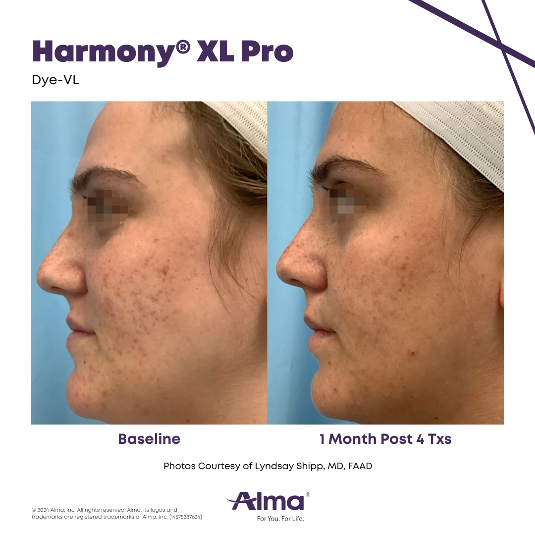 Before and After Harmony Alma Laser at Lush MedSpa Tuscaloosa, AL