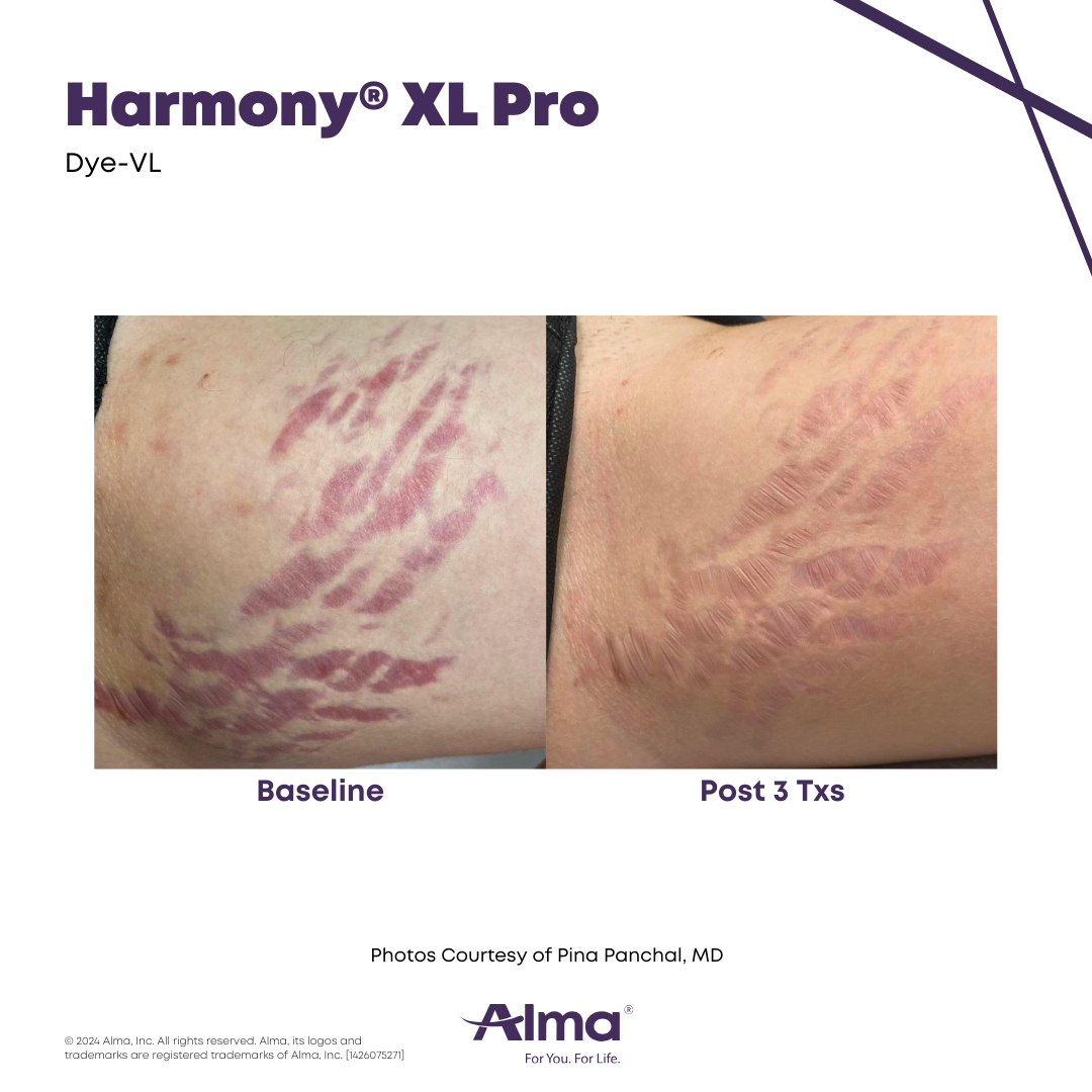Before and After Harmony Alma Laser at Lush MedSpa Tuscaloosa, AL