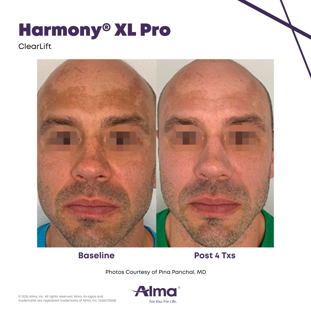 Before and After Harmony Alma Laser at Lush MedSpa Tuscaloosa, AL