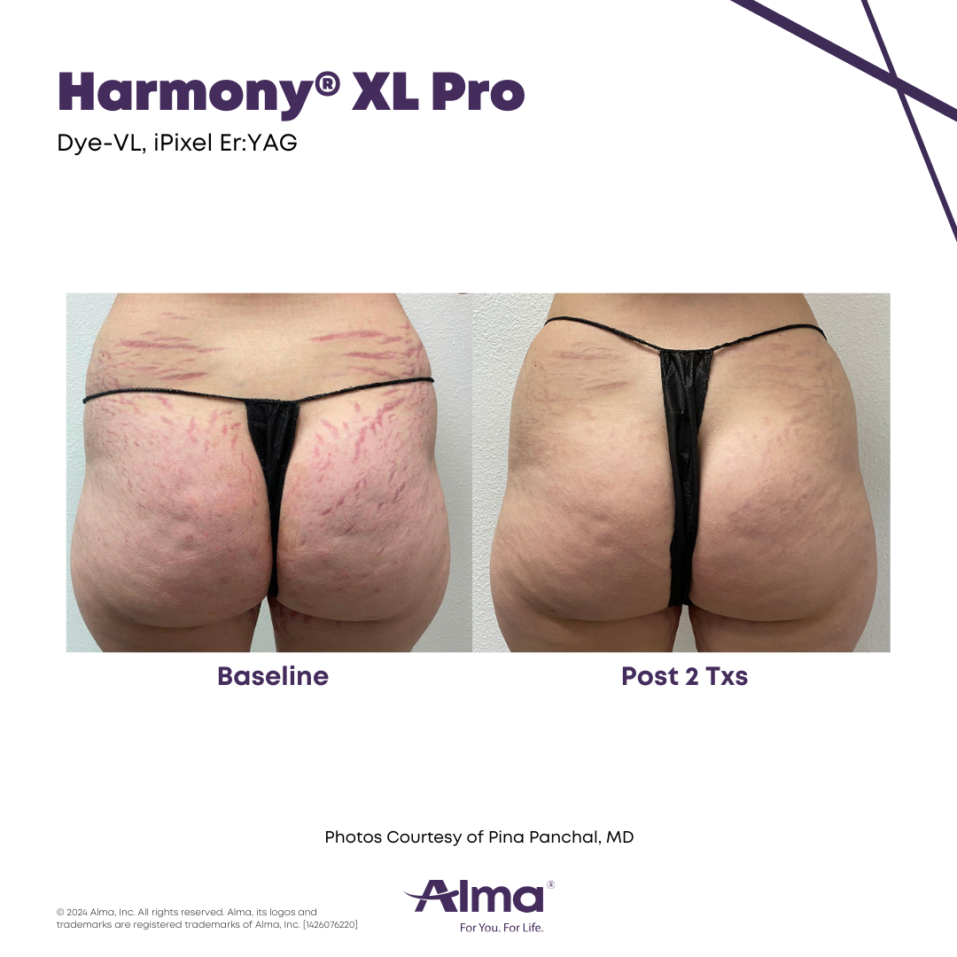 Before and After Harmony Alma Laser at Lush MedSpa Tuscaloosa, AL