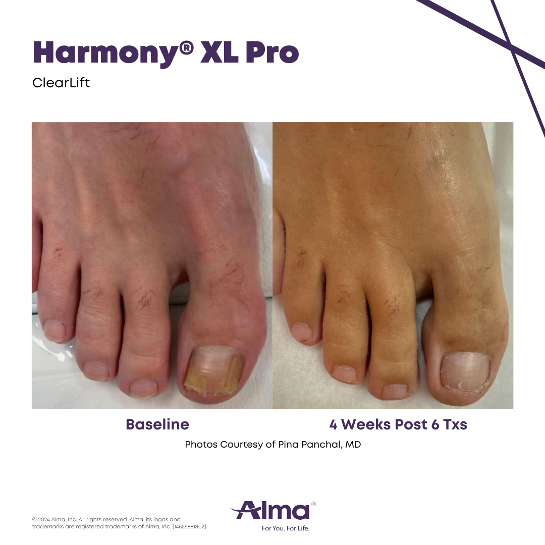 Before and After Harmony Alma Laser at Lush MedSpa Tuscaloosa, AL