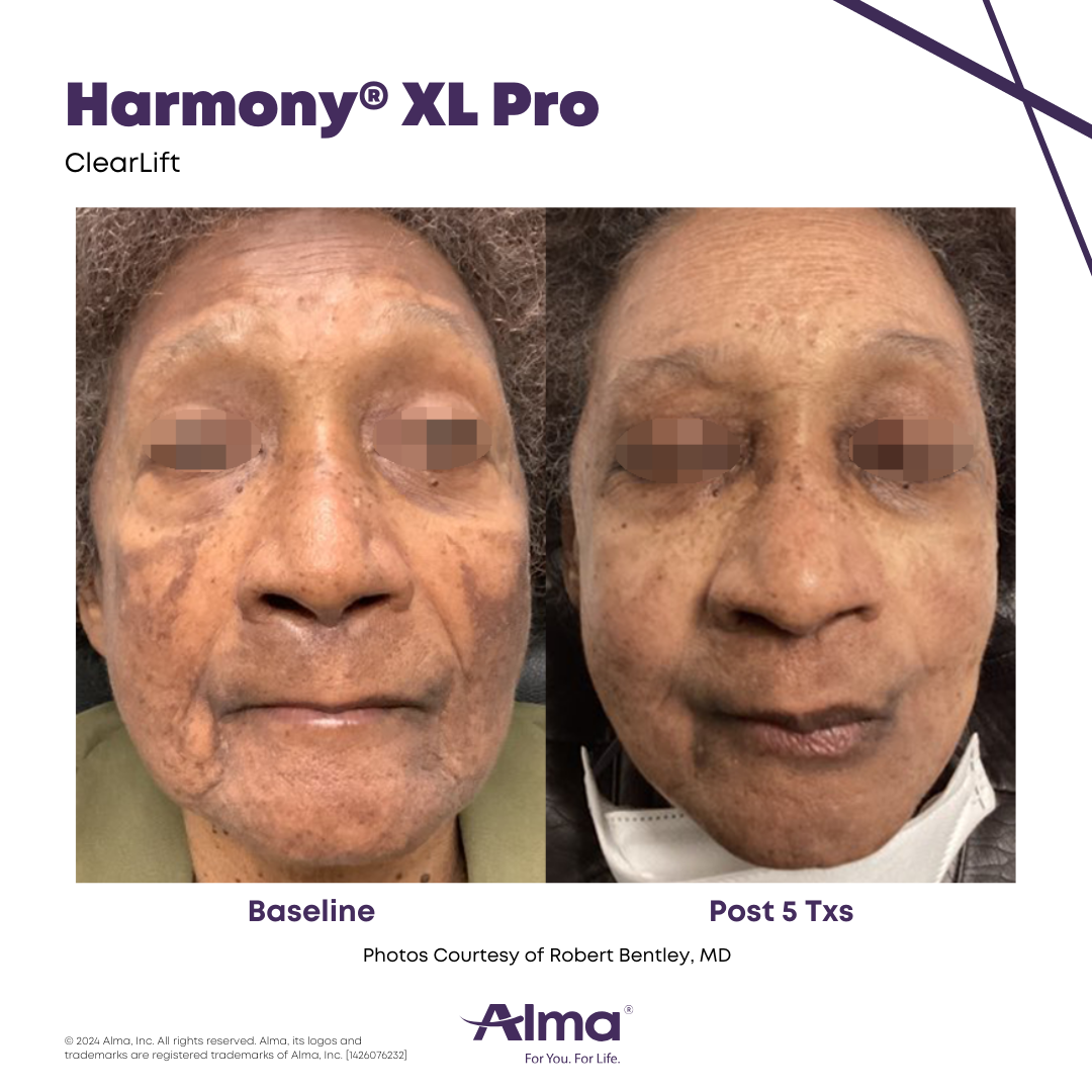 Before and After Harmony Alma Laser at Lush MedSpa Tuscaloosa, AL