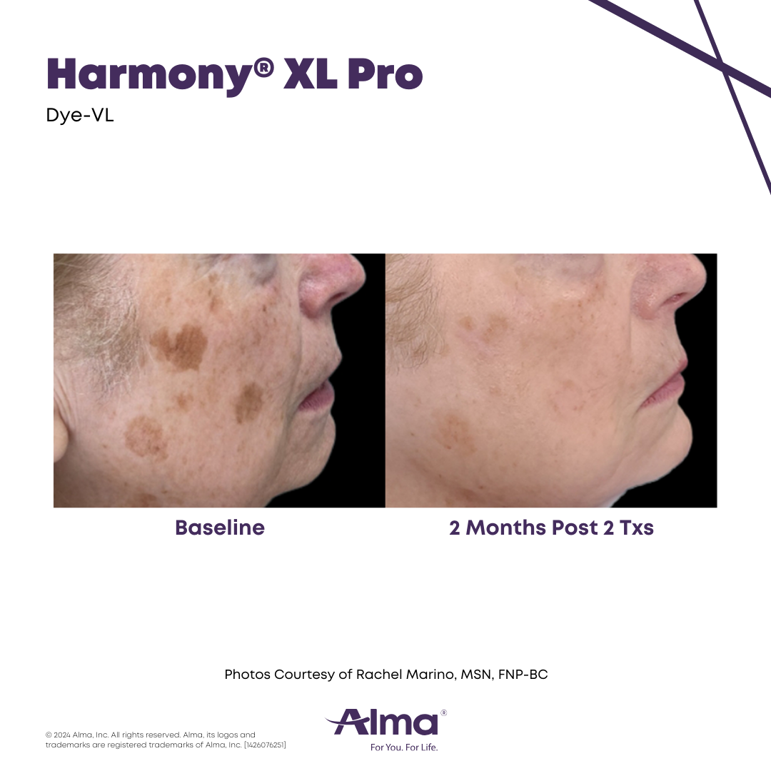 Before and After Harmony Alma Laser at Lush MedSpa Tuscaloosa, AL