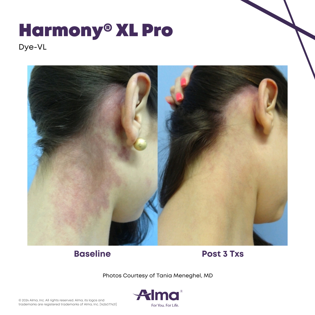 Before and After Harmony Alma Laser at Lush MedSpa Tuscaloosa, AL