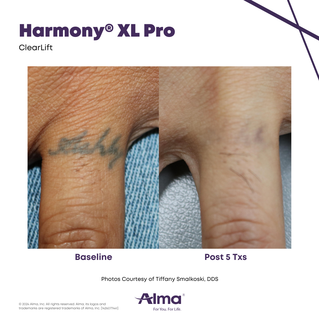 Before and After Harmony Alma Laser at Lush MedSpa Tuscaloosa, AL
