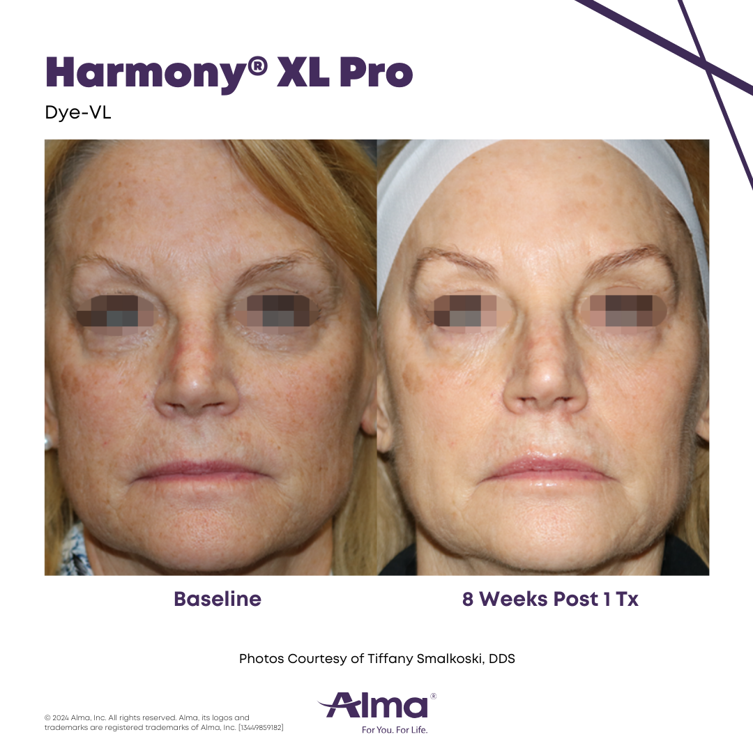 Before and After Harmony Alma Laser at Lush MedSpa Tuscaloosa, AL
