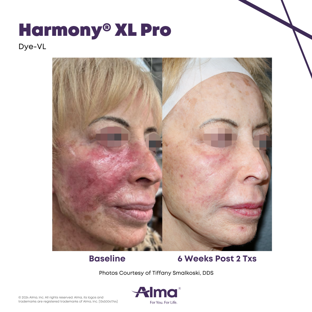 Before and After Harmony Alma Laser at Lush MedSpa Tuscaloosa, AL
