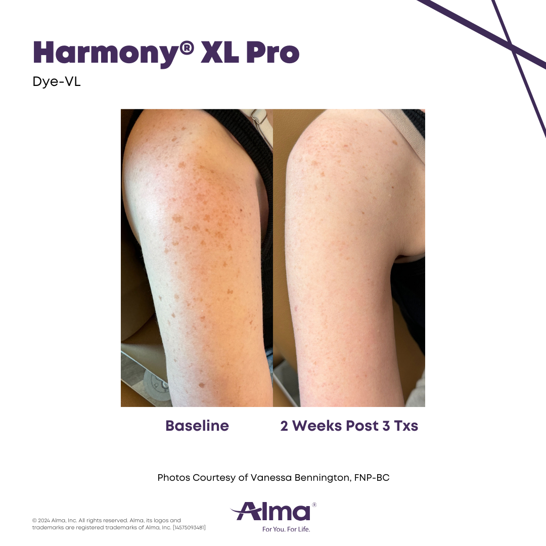 Before and After Harmony Alma Laser at Lush MedSpa Tuscaloosa, AL